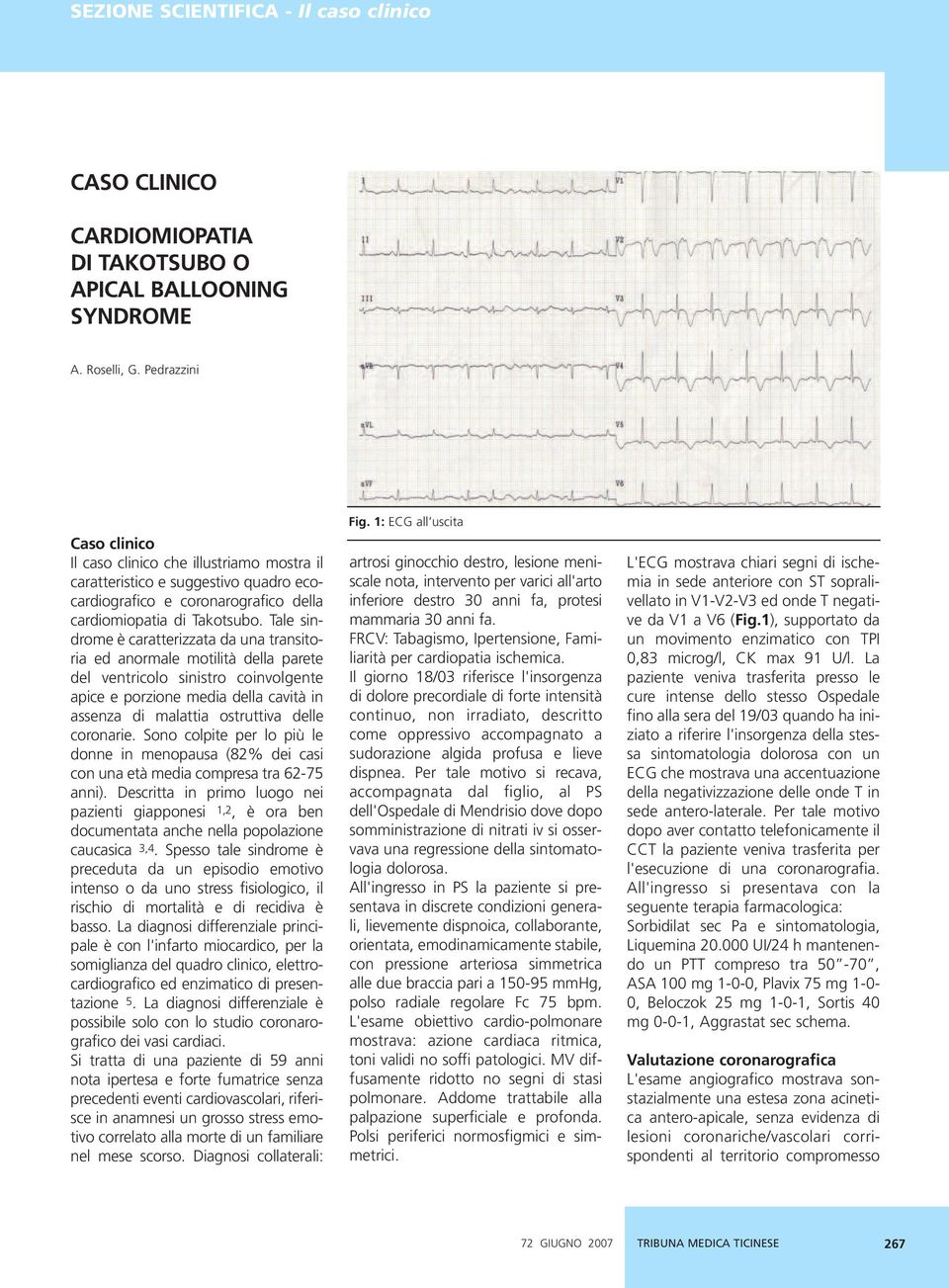 Tale sindrome è caratterizzata da una transitoria ed anormale motilità della parete del ventricolo sinistro coinvolgente apice e porzione media della cavità in assenza di malattia ostruttiva delle