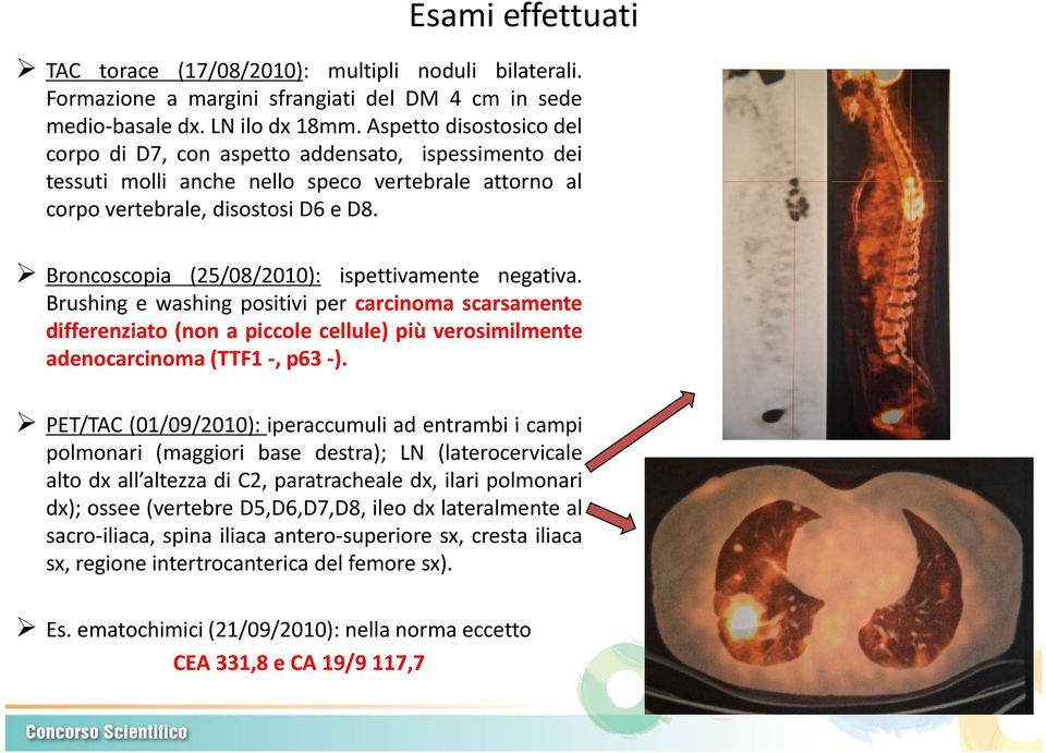 Broncoscopia (25/08/2010): ispettivamente negativa. Brushing e washing positivi per carcinoma scarsamente differenziato (non a piccole cellule) più verosimilmente adenocarcinoma (TTF1, p63 ).