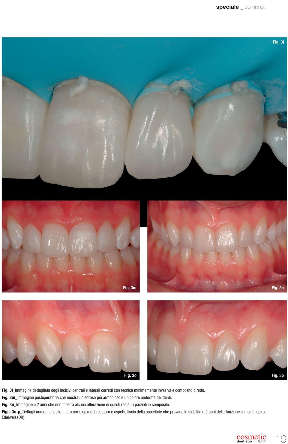 3m_Immagine postoperatoria che mostra un sorriso più armonioso e un colore uniforme dei denti. Fig.