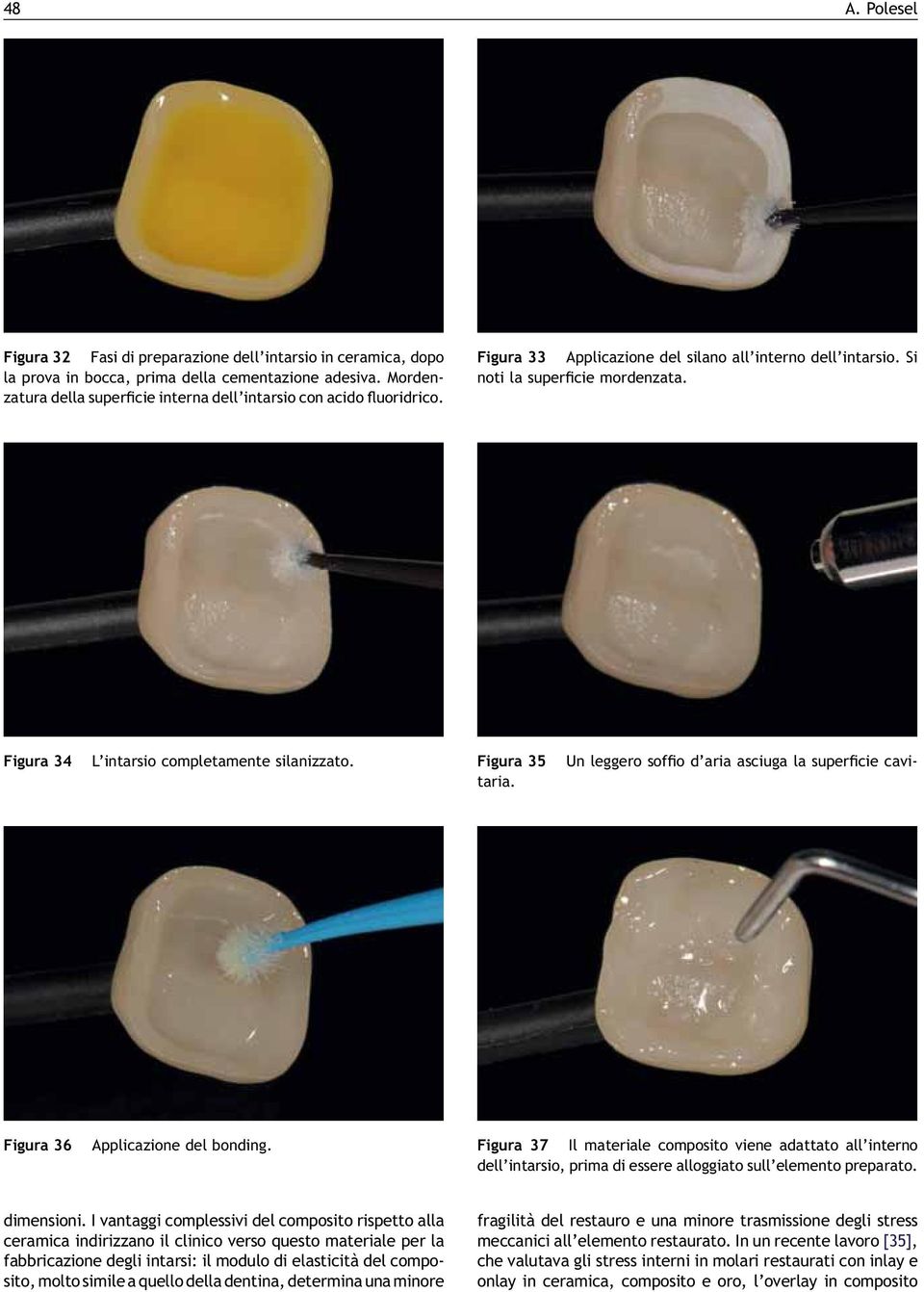 Figura 34 L intarsio completamente silanizzato. Figura 35 Un leggero soffio d aria asciuga la superficie cavitaria. Figura 36 Applicazione del bonding.