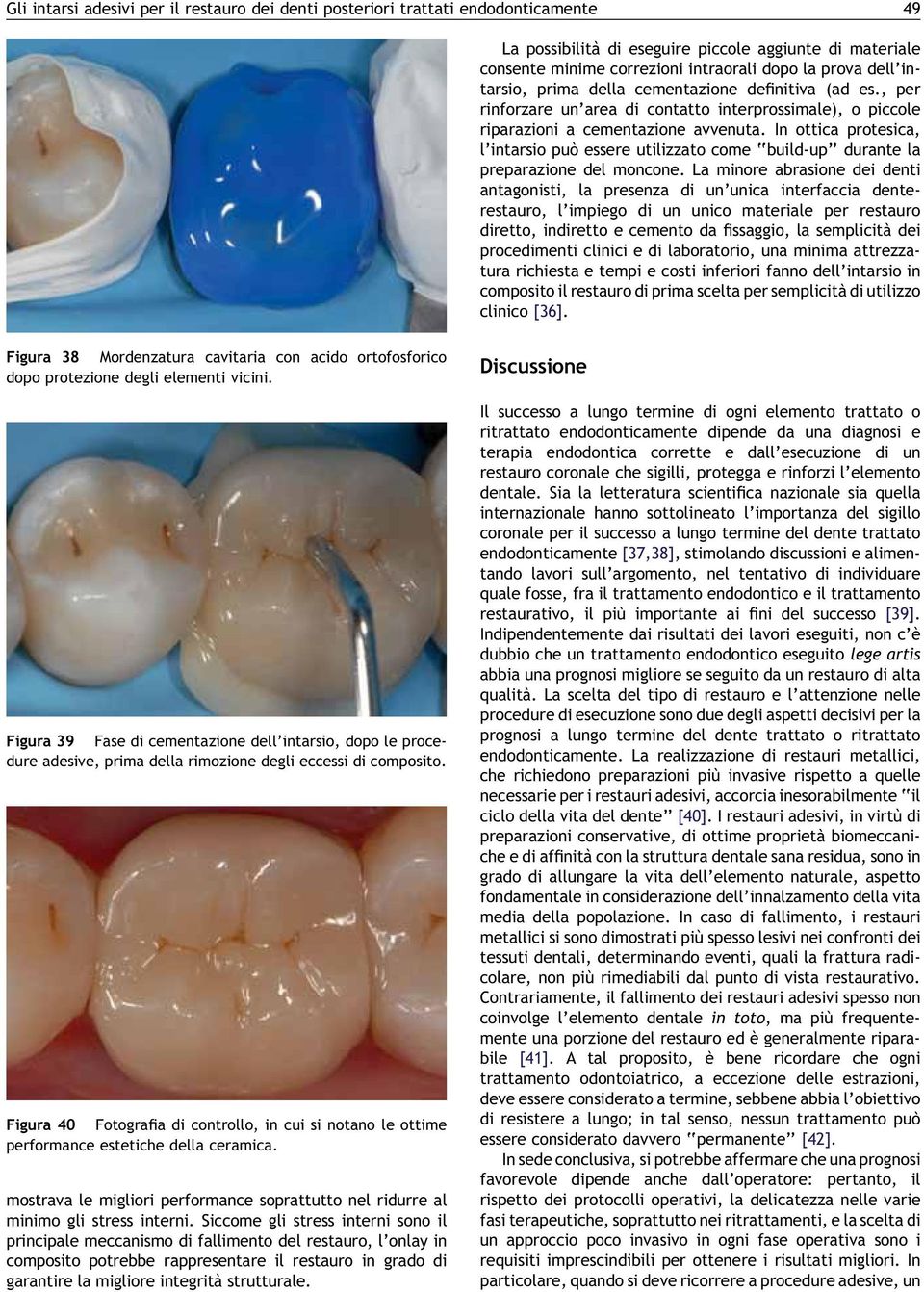 In ottica protesica, l intarsio può essere utilizzato come build-up durante la preparazione del moncone.