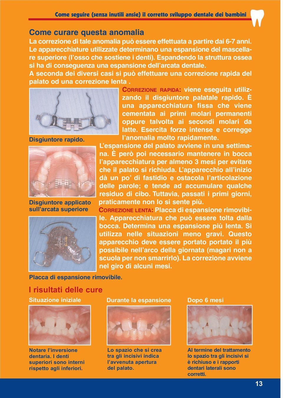 A seconda dei diversi casi si può effettuare una correzione rapida del palato od una correzione lenta. CORREZIONE RAPIDA: viene eseguita utilizzando il disgiuntore palatale rapido.