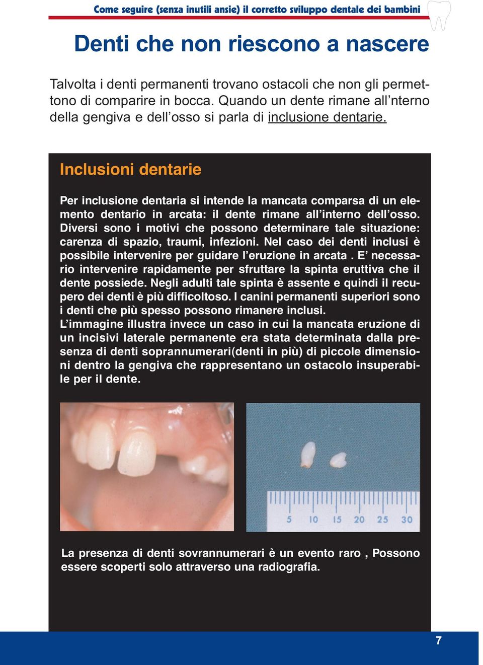 Inclusioni dentarie Per inclusione dentaria si intende la mancata comparsa di un elemento dentario in arcata: il dente rimane all interno dell osso.