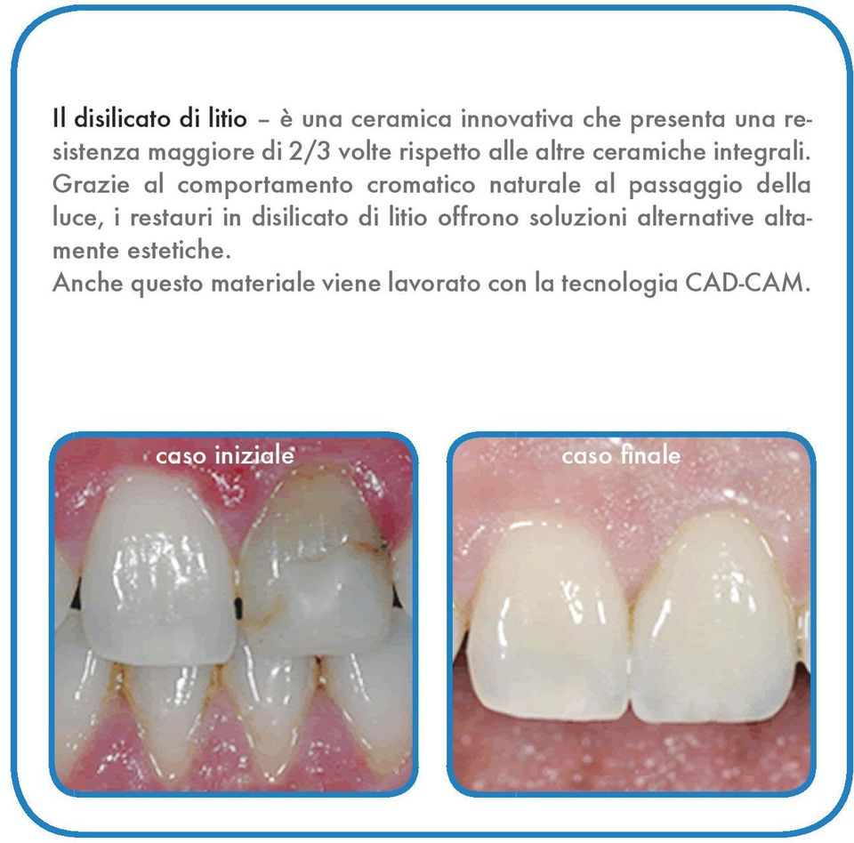 Grazie al comportamento cromatico naturale al passaggio della luce, i restauri in disilicato di