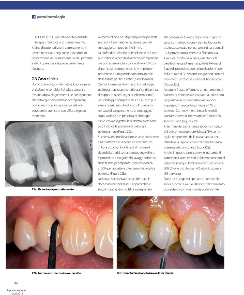 3 Caso clinico Uomo di anni 43, non fumatore, buona igiene orale, buone condizioni di salute generale (assenza di patologie sistemiche predisponenti alle patologie parodontali e perimplantari),