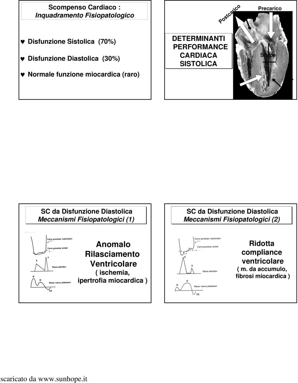 da Disfunzione Diastolica Meccanismi Fisiopatologici (1) SC da Disfunzione Diastolica Meccanismi Fisiopatologici (2) Anomalo