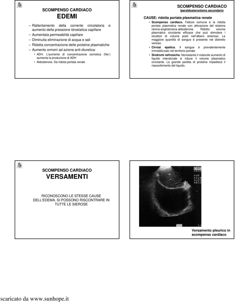 Da ridotta portata renale Iperaldosteronismo secondario CAUSE: ridotta portata plasmatica renale Scompenso cardiaco.