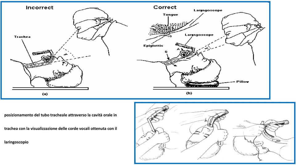 trachea con la visualizzazione