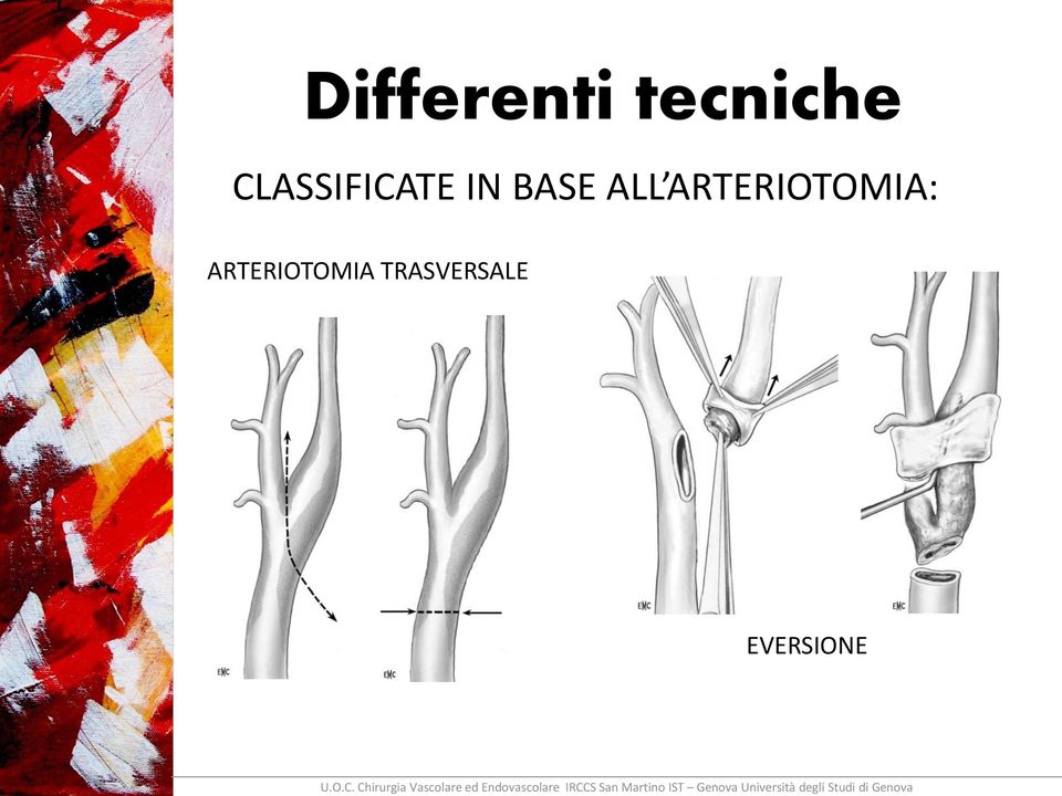 ALL ARTERIOTOMIA: