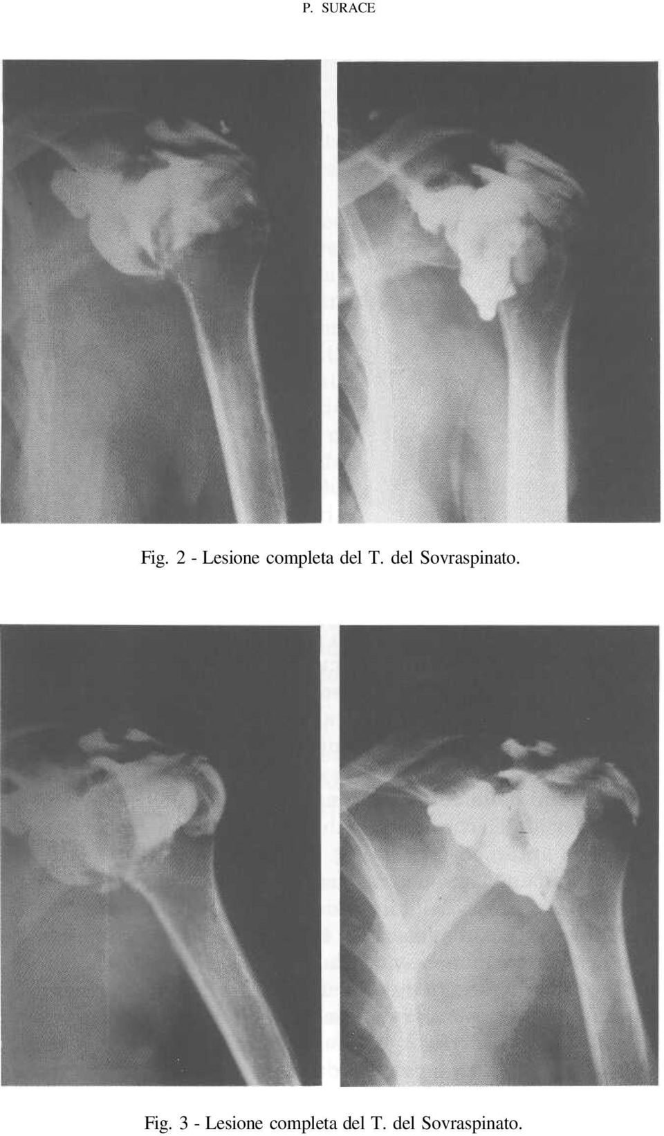 del Sovraspinato. Fig.