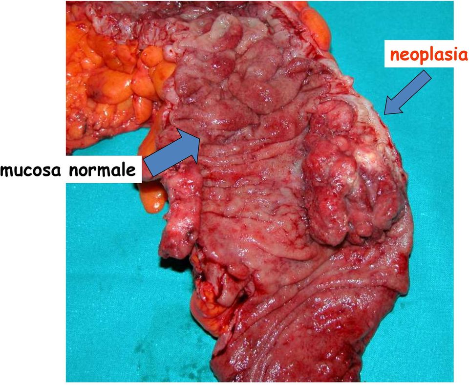 neoplasia