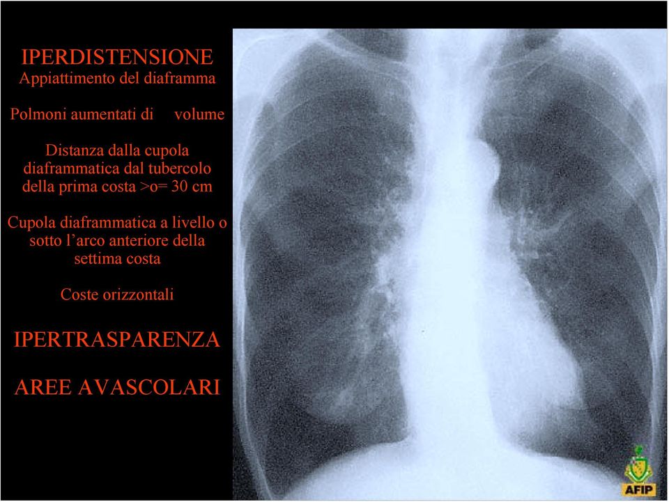 costa >o= 30 cm Cupola diaframmatica a livello o sotto l arco