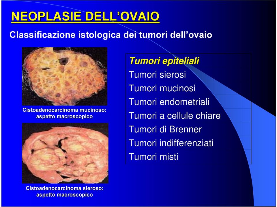 sierosi Tumori mucinosi Tumori endometriali Tumori a cellule chiare Tumori di