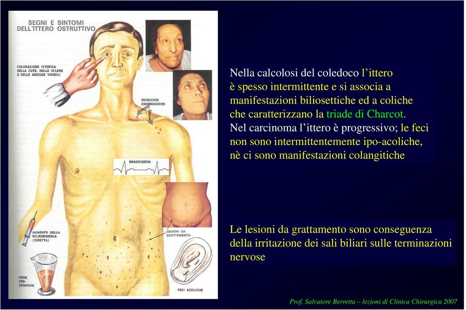 Nel carcinoma l ittero è progressivo; le feci non sono intermittentemente ipo-acoliche, nè ci sono