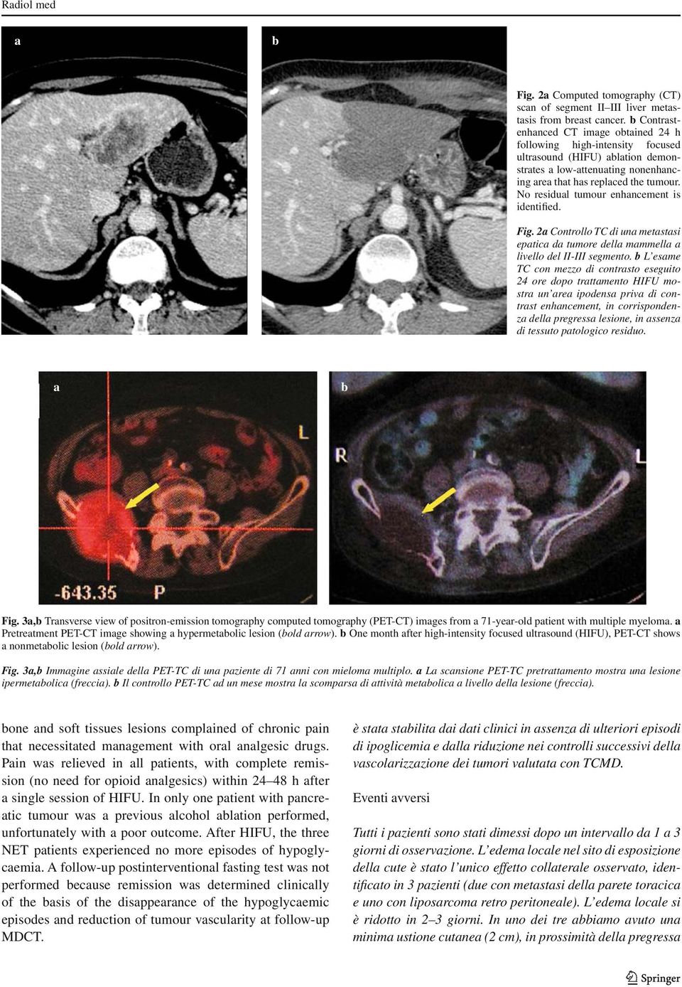 No residual tumour enhancement is identified. Fig. 2a Controllo TC di una metastasi epatica da tumore della mammella a livello del II-III segmento.