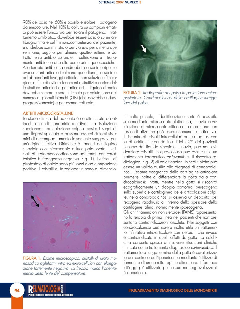 Il ceftriaxone è il trattamento antibiotico di scelta per le artriti gonococciche.