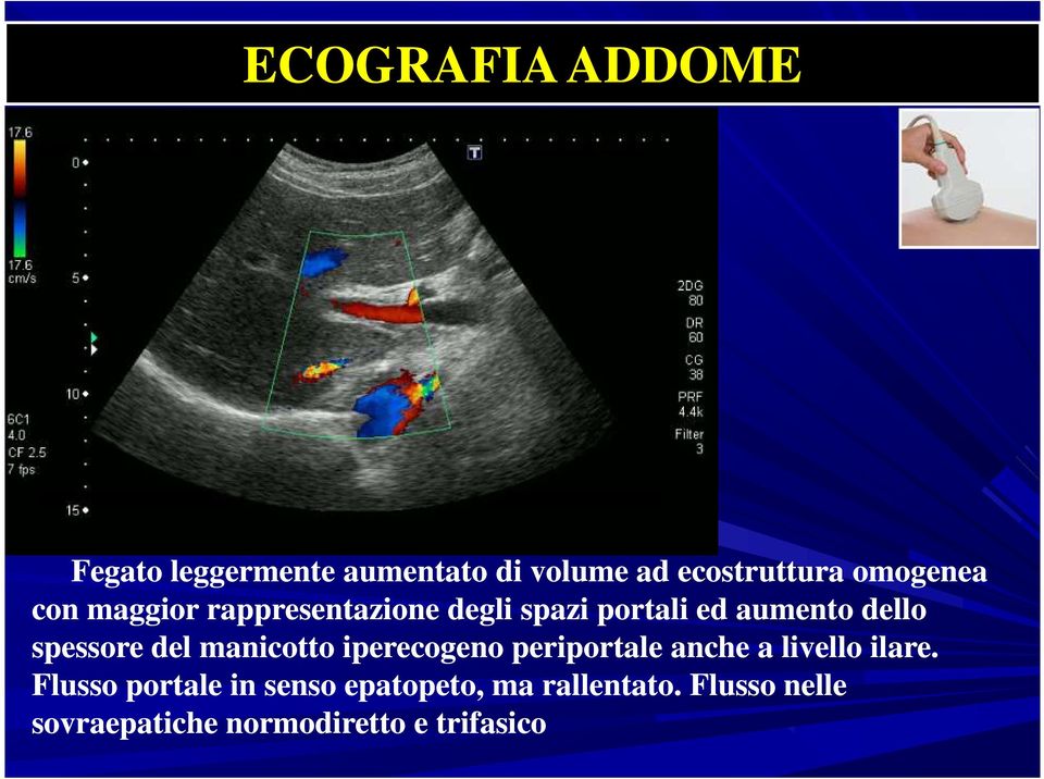 spessore del manicotto iperecogeno periportale anche a livello ilare.