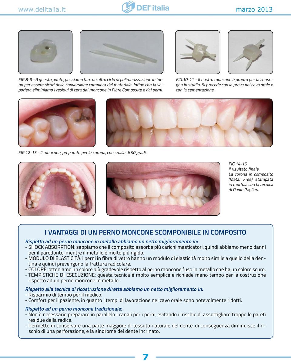 Si procede con la prova nel cavo orale e con la cementazione. FIG.12-13 - Il moncone, preparato per la corona, con spalla di 90 gradi. FIG.14-15 Il risultato finale.