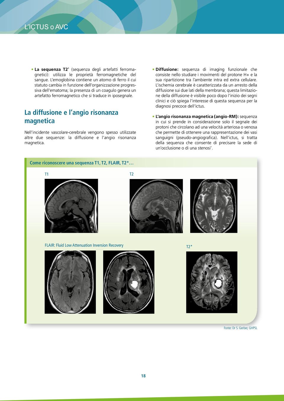 iposegnale. La diffusione e l angio risonanza magnetica Nell incidente vascolare-cerebrale vengono spesso utilizzate altre due sequenze: la diffusione e l angio risonanza magnetica.