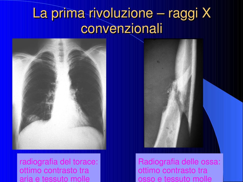 tra aria e tessuto molle Radiografia delle