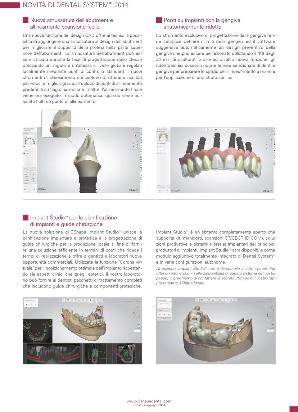 La smussatura dell'abutment può essere attivata durante la fase di progettazione dello stesso utilizzando un angolo e un'altezza a livello globale regolati localmente mediante punti di controllo