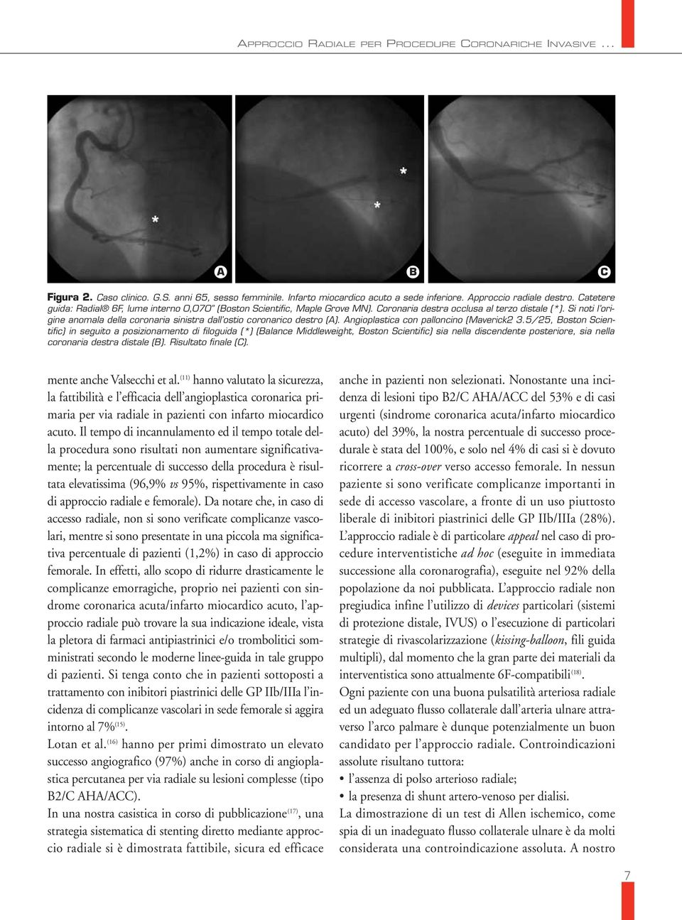 Si noti l origine anomala della coronaria sinistra dall ostio coronarico destro (A). Angioplastica con palloncino (Maverick2 3.