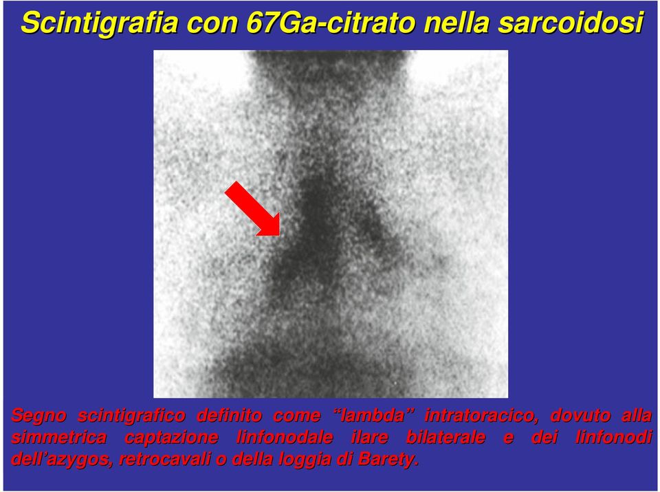 alla simmetrica captazione linfonodale ilare bilaterale e