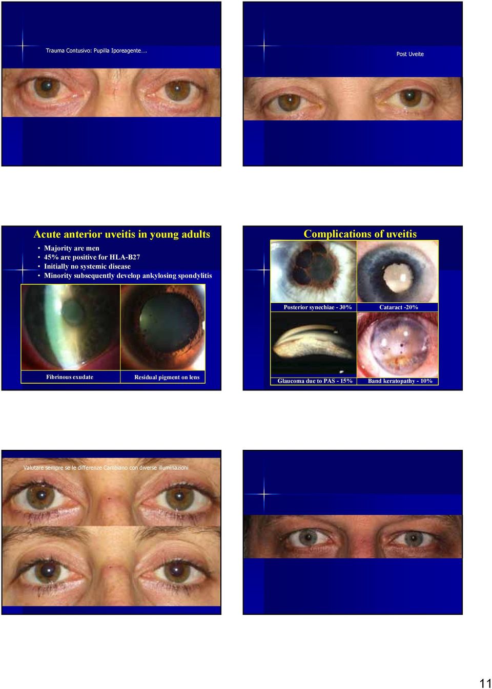 systemic disease Minority subsequently develop ankylosing spondylitis Complications of uveitis Posterior