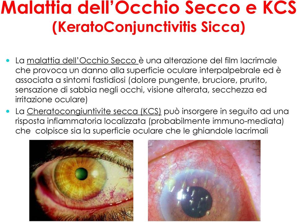 sensazione di sabbia negli occhi, visione alterata, secchezza ed irritazione oculare) La Cheratocongiuntivite secca (KCS) può insorgere