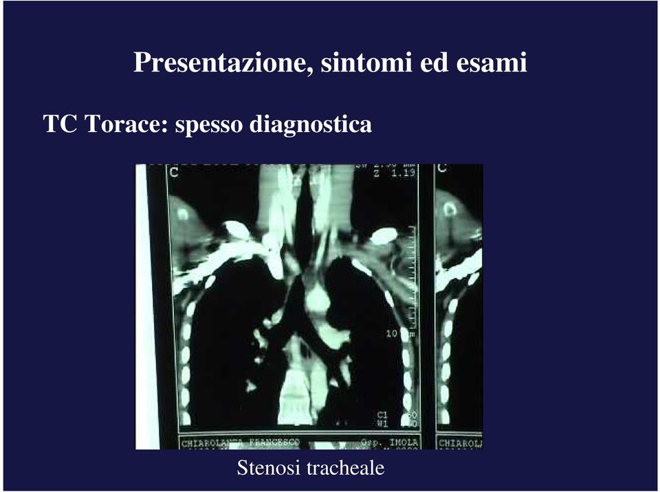 Torace: spesso