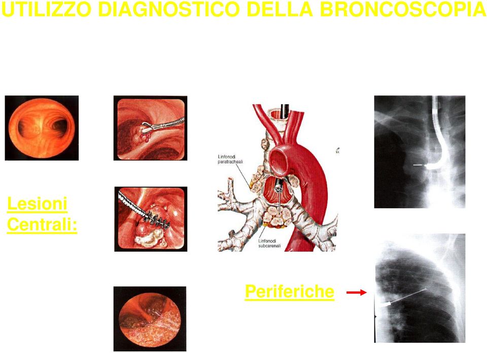 transbronchiale sotto fluoroscopia Spazzolamento Lesioni Centrali: >