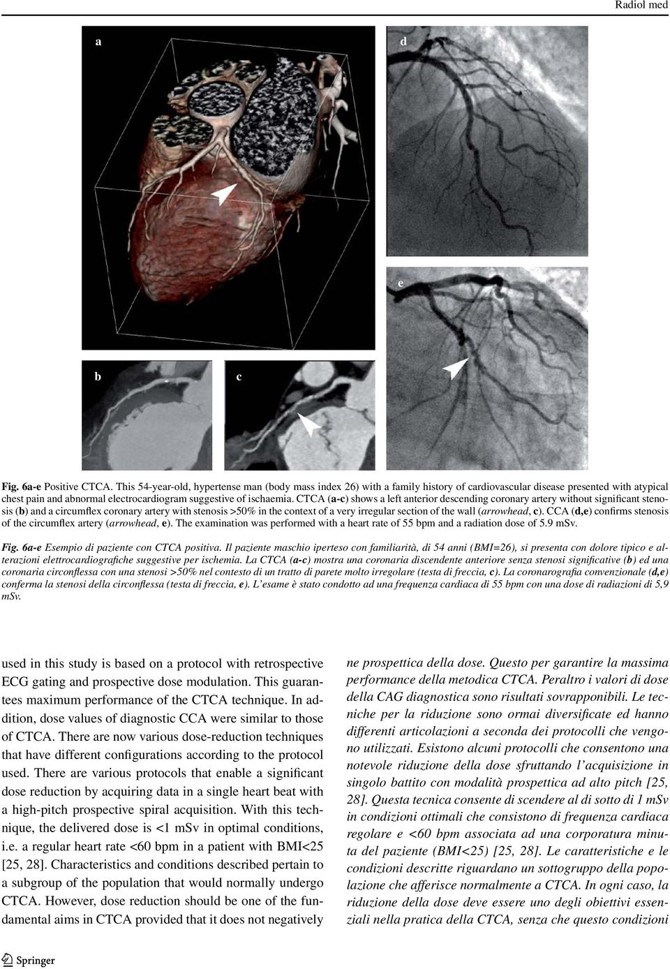 CTCA (a-c) shows a left anterior descending coronary artery without significant stenosis (b) and a circumflex coronary artery with stenosis >50% in the context of a very irregular section of the wall