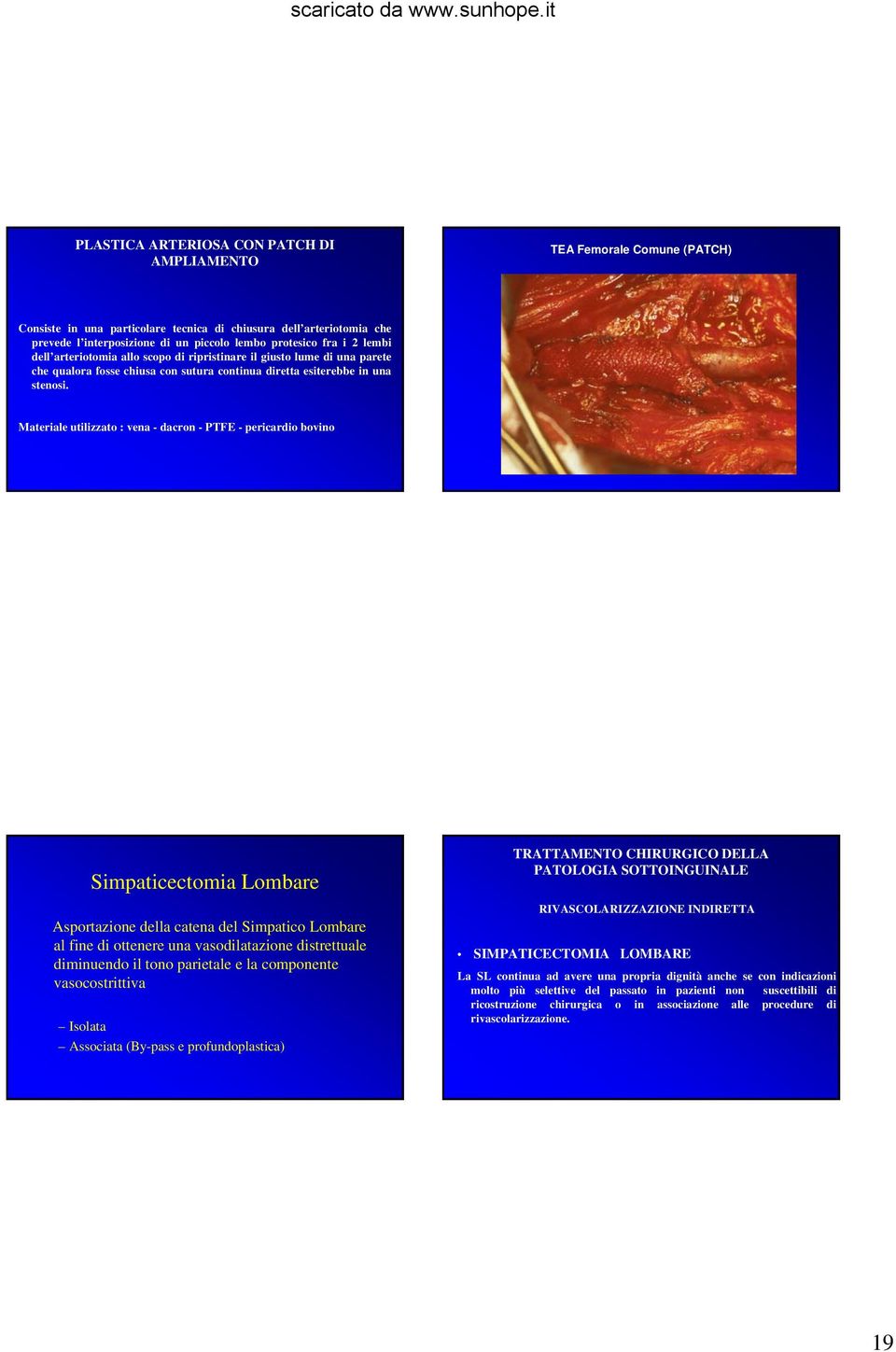 Materiale utilizzato : vena - dacron - PTFE - pericardio bovino Simpaticectomia Lombare Asportazione della catena del Simpatico Lombare al fine di ottenere una vasodilatazione distrettuale diminuendo