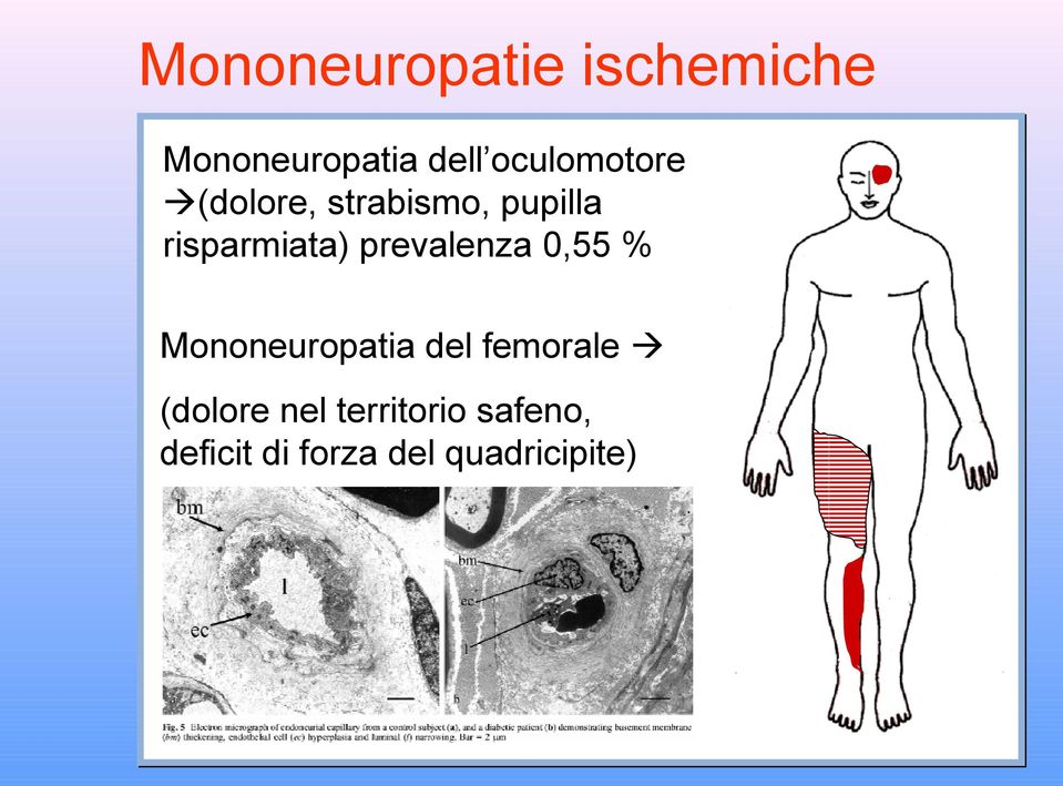 prevalenza 0,55 % Mononeuropatia del femorale