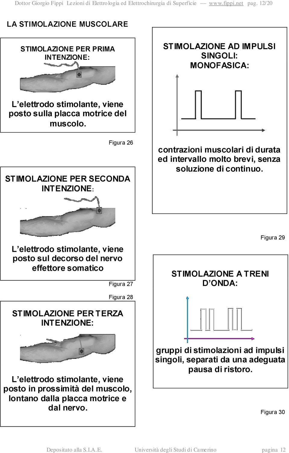 Figura 26 STIMOLAZIONE PER SECONDA INTENZIONE: contrazioni muscolari di durata ed intervallo molto brevi, senza soluzione di continuo.