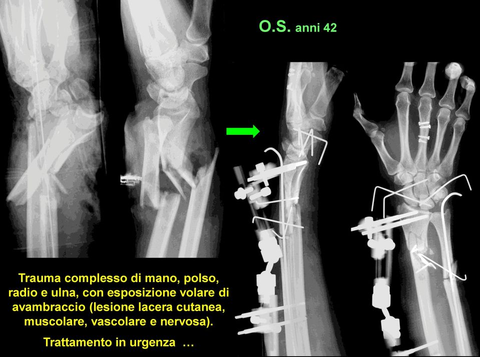 di avambraccio (lesione lacera cutanea,