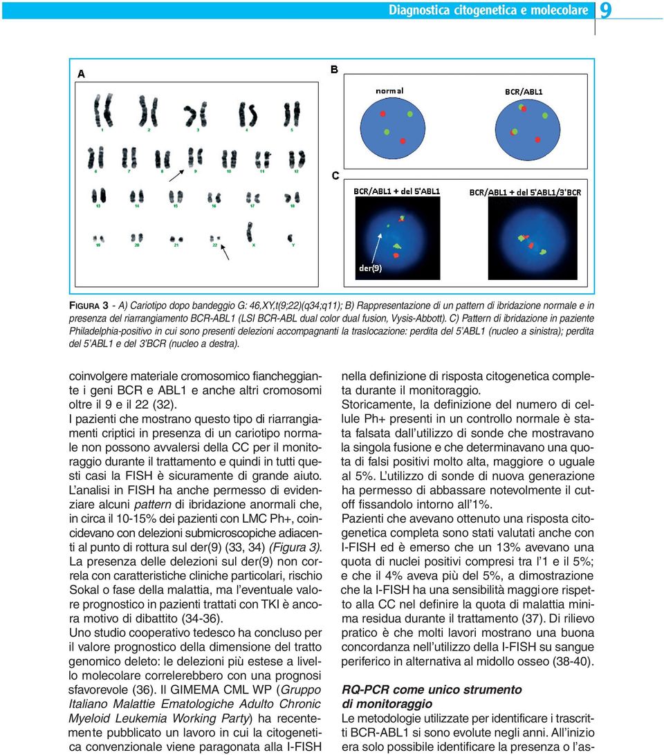 C) Pattern di ibridazione in paziente Philadelphia-positivo in cui sono presenti delezioni accompagnanti la traslocazione: perdita del 5 ABL1 (nucleo a sinistra); perdita del 5 ABL1 e del 3 BCR