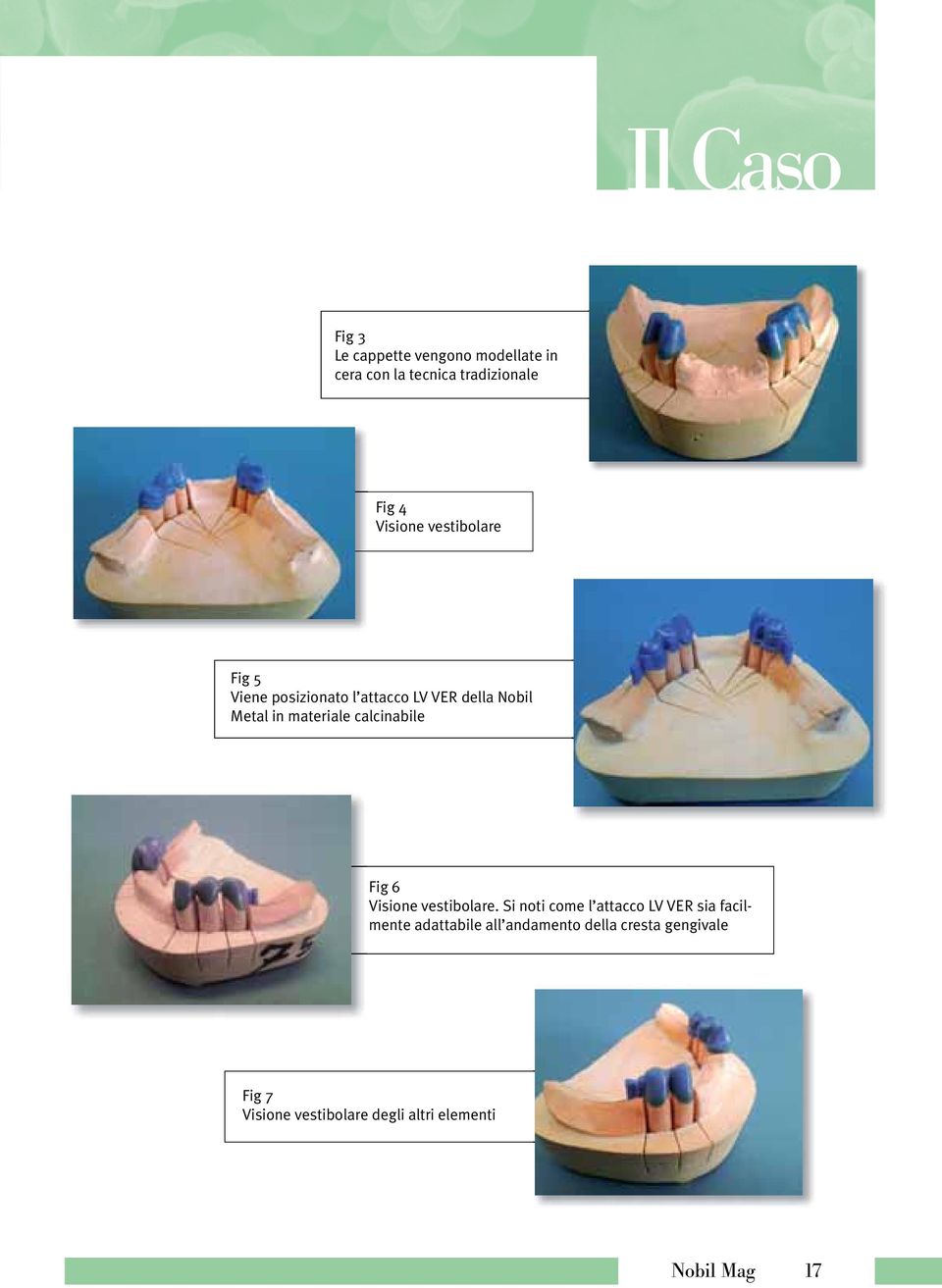 calcinabile Fig 6 Visione vestibolare.