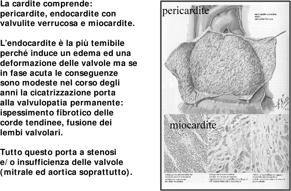 conseguenze sono modeste nel corso degli anni la cicatrizzazione porta alla valvulopatia permanente: ispessimento