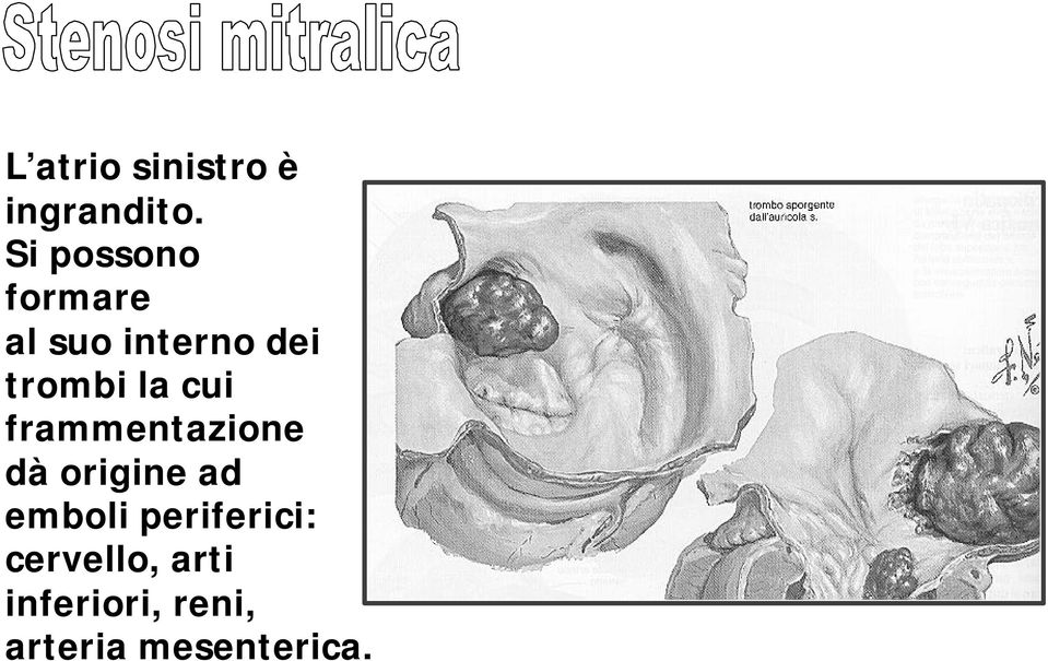 la cui frammentazione dà origine ad emboli