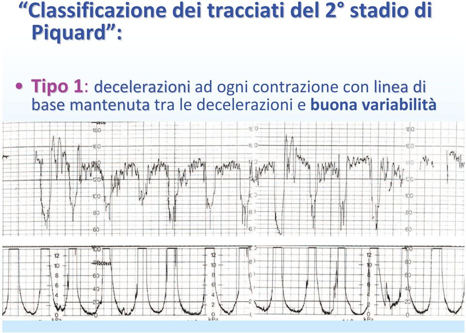 ogni contrazione con linea di linea di base