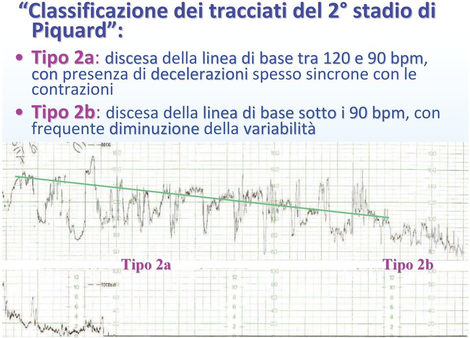 decelerazionispesso sincrone con le contrazioni Tipo 2b: discesa della linea