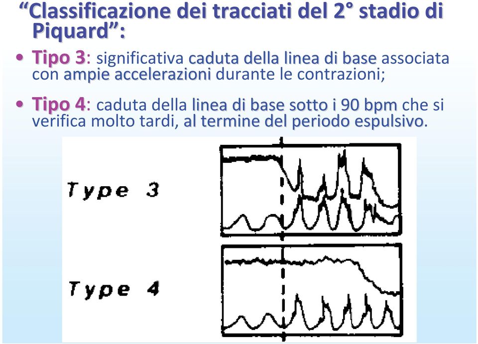 accelerazionidurante le contrazioni; Tipo 4 Tipo 4: caduta della linea di