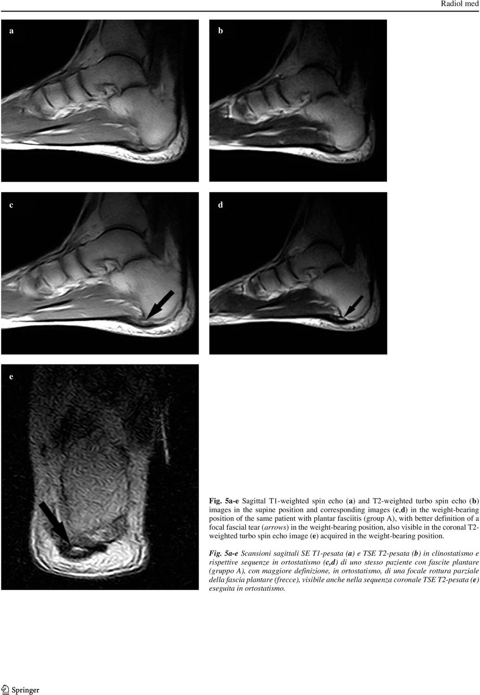 plantar fasciitis (group A), with better definition of a focal fascial tear (arrows) in the weight-bearing position, also visible in the coronal T2- weighted turbo spin echo image (e) acquired in the