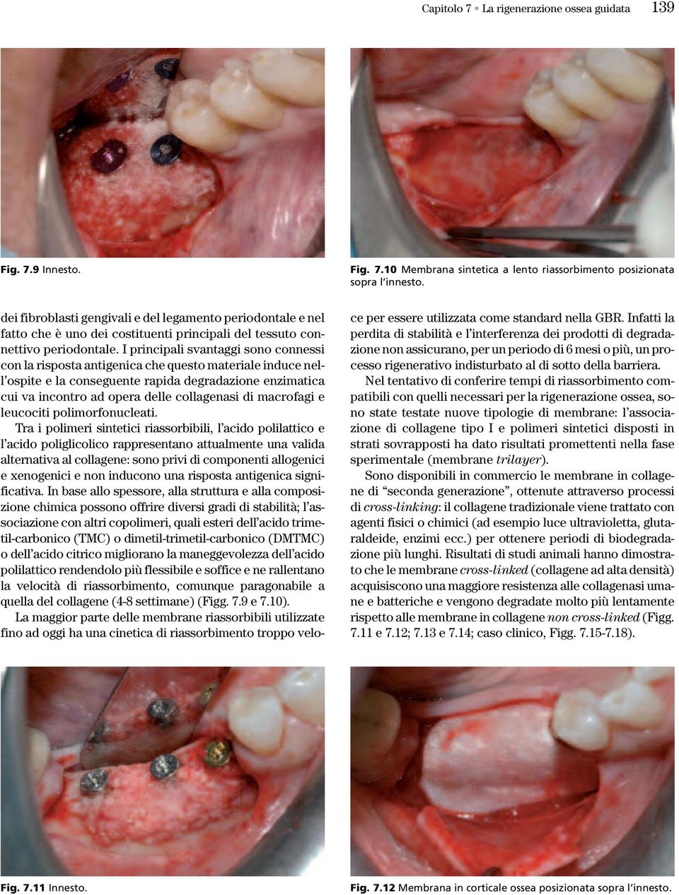 I principali svantaggi sono connessi con la risposta antigenica che questo materiale induce nell ospite e la conseguente rapida degradazione enzimatica cui va incontro ad opera delle collagenasi di