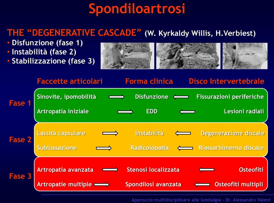 Intervertebrale Fase 1 Sinovite, ipomobilità Disfunzione Fissurazioni periferiche Artropatia iniziale EDD Lesioni radiali Fase 2