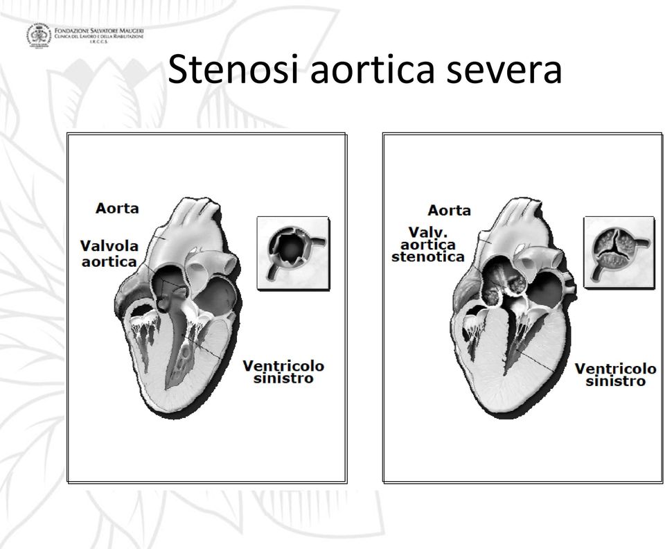 severa