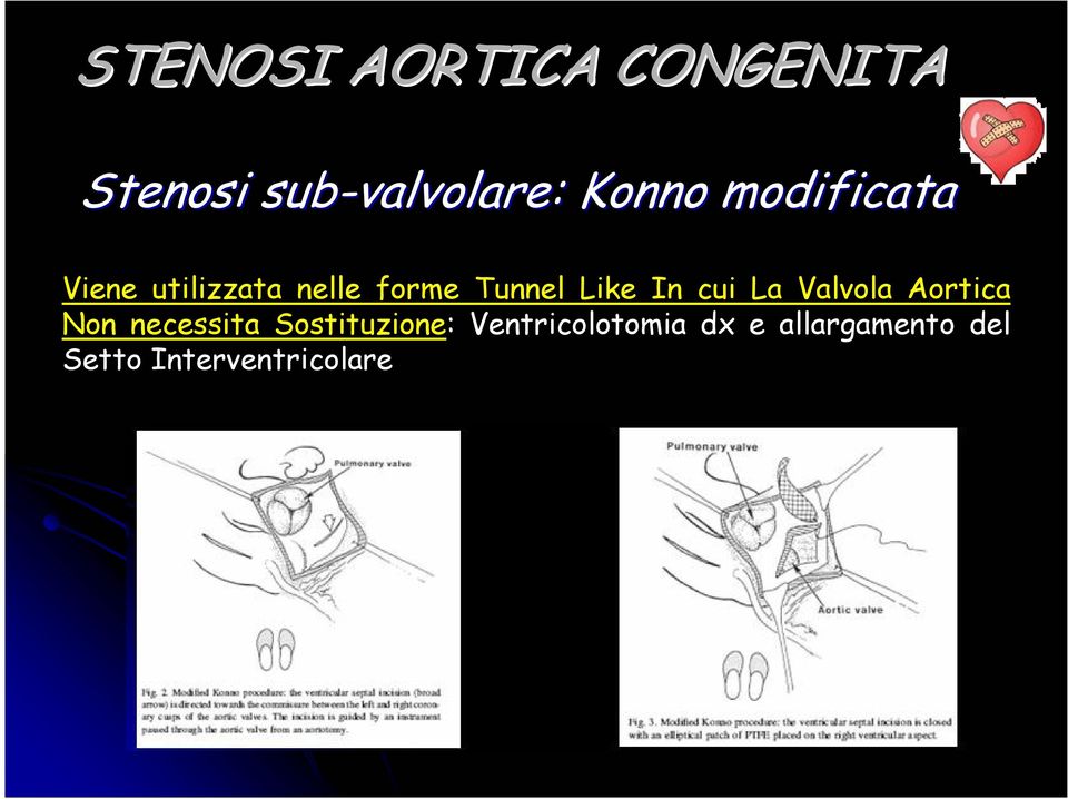 cui La Valvola Aortica Non necessita Sostituzione: