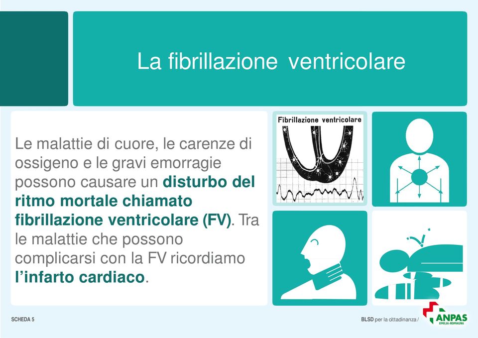 chiamato fibrillazione ventricolare (FV).