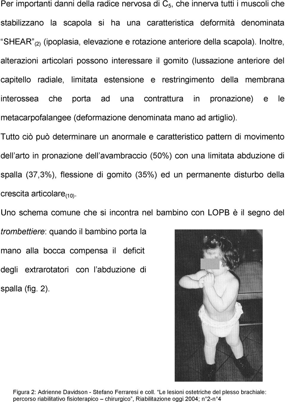 Inoltre, alterazioni articolari possono interessare il gomito (lussazione anteriore del capitello radiale, limitata estensione e restringimento della membrana interossea che porta ad una contrattura